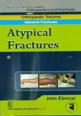 A Typical Fractures