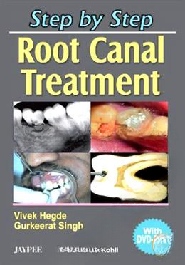 Step by Step Root Canal Treatment (with DVD Rom) (Paperback)