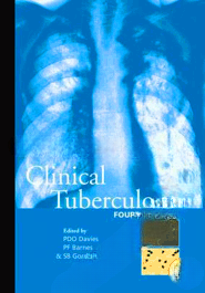 Clinical Tuberculosis